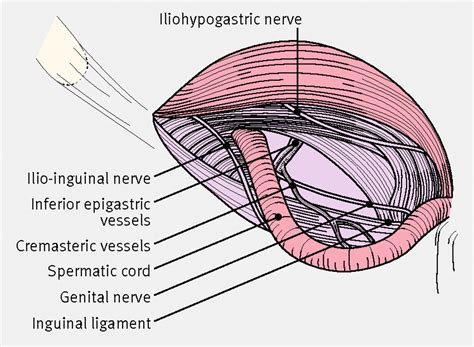 inguinal hernia anatomy diagram
